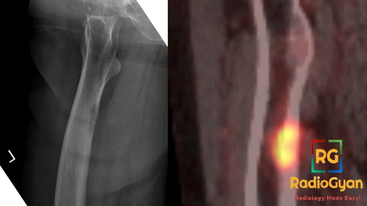 X-ray and PET scan images showing cookie-bite metastasis in the femur from lung carcinoma.