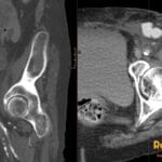 CT scan showing a femoral artery pseudoaneurysm after coronary angiogram access