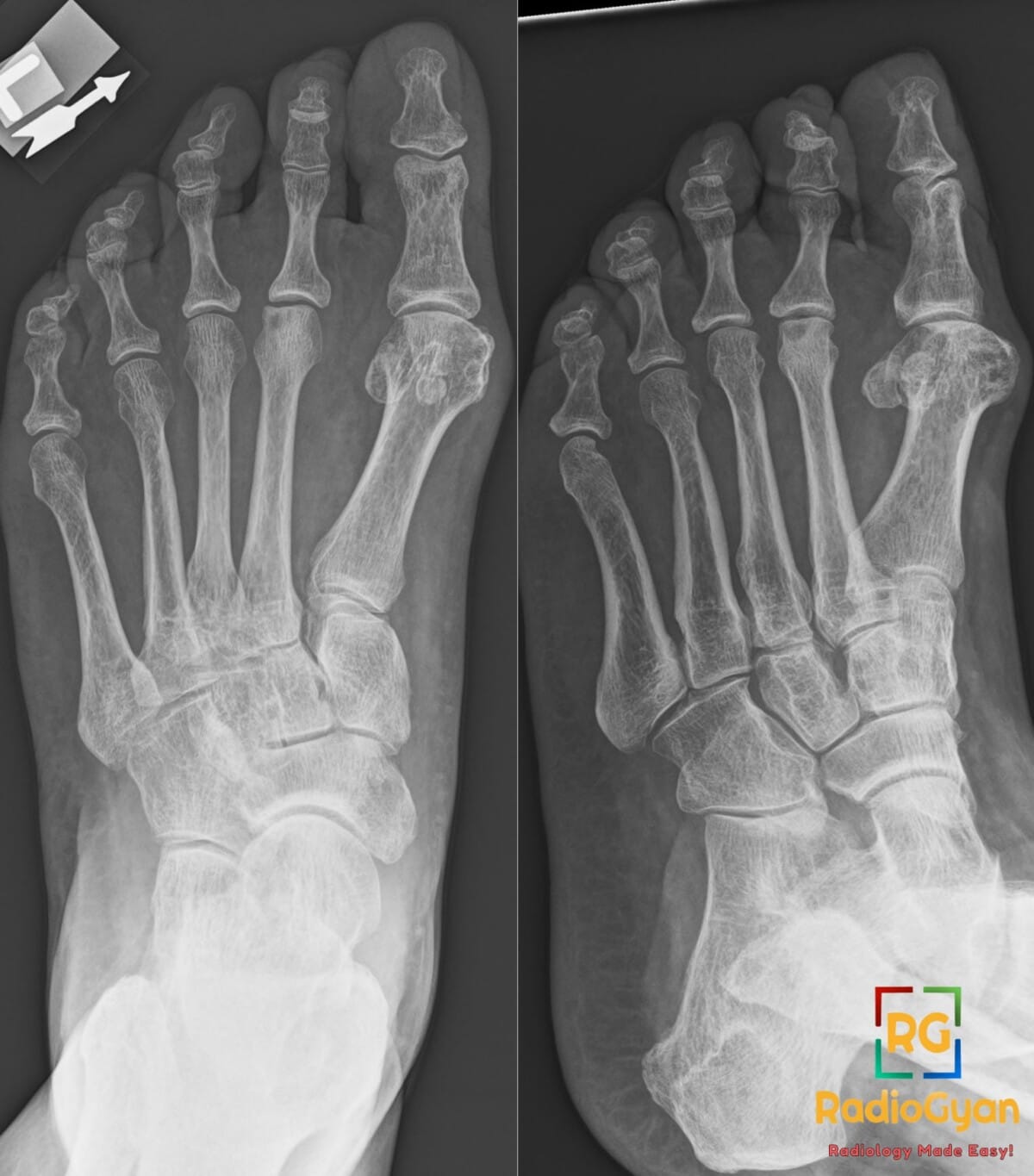 AP and oblique X-rays of a foot showing Freiberg's disease of the second metatarsal head characterized by sclerosis and flattening.