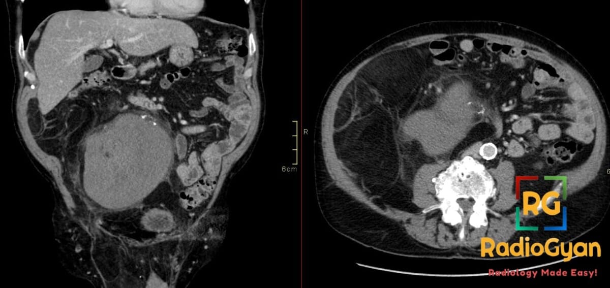 CT scan showing a large dedifferentiated retroperitoneal liposarcoma on the right side of the abdomen in coronal and axial views.