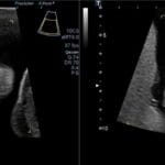 Antenatal ultrasound showing a fetal profile with a noticeable left cleft lip. Early detection of facial anomalies.