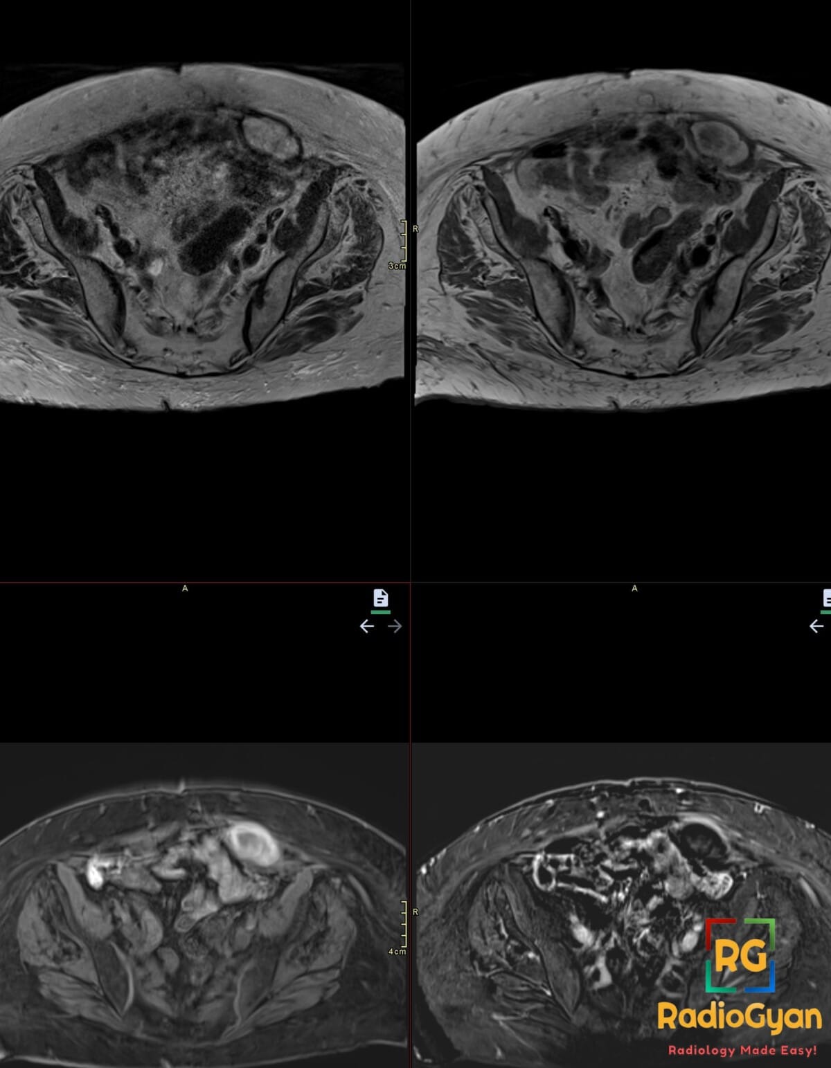 Axial T1 fat-saturated MRI of the abdomen in an elderly patient showing a left rectus sheath hematoma appearing as hyperintensity, potentially mistaken for a mass.