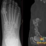 AP X-ray and coronal CT of the foot showing a Lisfranc injury with an avulsed bone fragment (fleck sign).