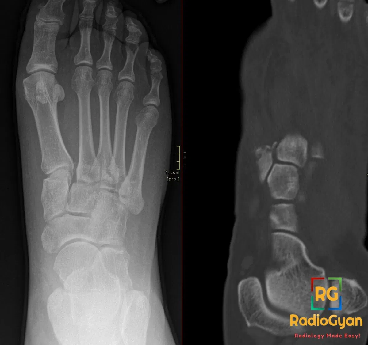 AP X-ray and coronal CT of the foot showing a Lisfranc injury with an avulsed bone fragment (fleck sign).