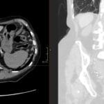 CT scan showing liver hyperdensity and basal pulmonary reticulations, characteristic of amiodarone toxicity.