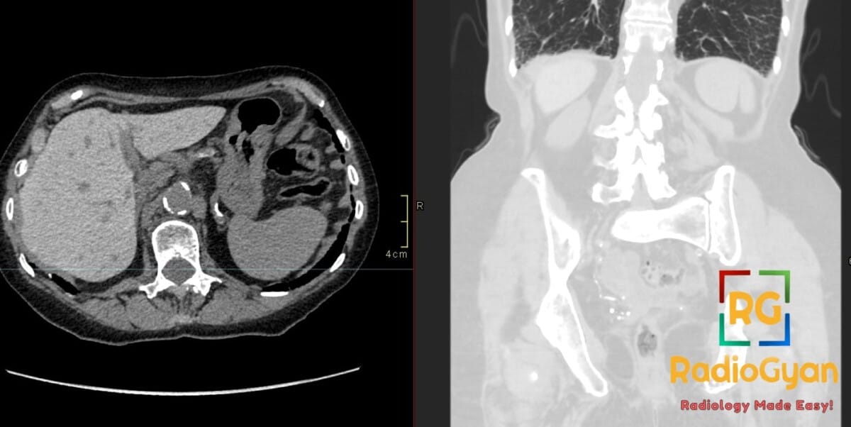 CT scan showing liver hyperdensity and basal pulmonary reticulations, characteristic of amiodarone toxicity.