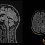 Sagittal and axial FLAIR MRI images showing hyperintense lesions in the pericallosal brain white matter and cervical spine.
