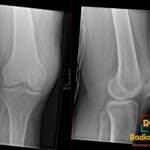 Anterior-posterior (left) and lateral (right) radiographs of the knee show a low-riding patella (patella baja).