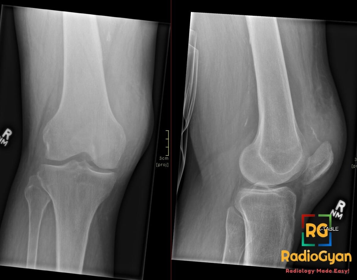 Anterior-posterior (left) and lateral (right) radiographs of the knee show a low-riding patella (patella baja).