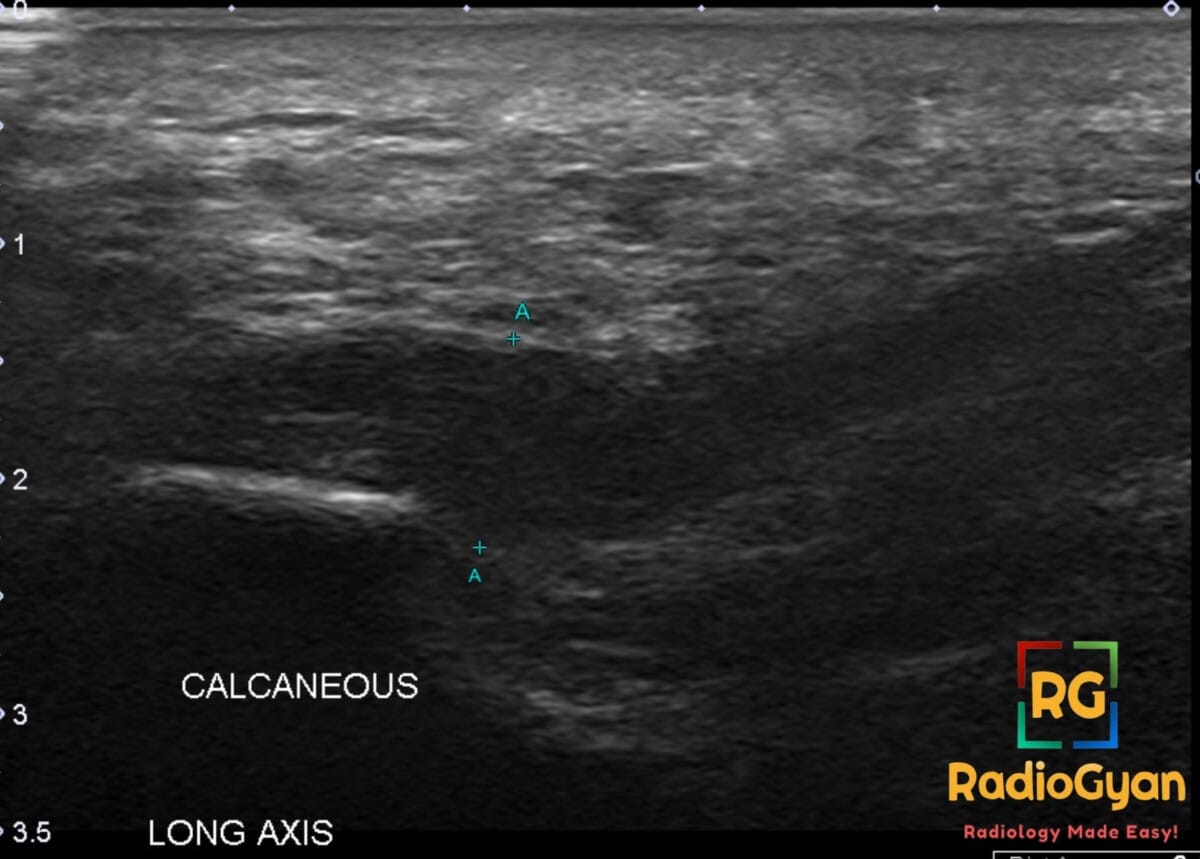 Ultrasound showing thickening of the plantar fascia in a patient with plantar fasciitis