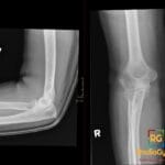 X-ray showing right radial neck fracture with visible lipohemarthrosis in the elbow joint.