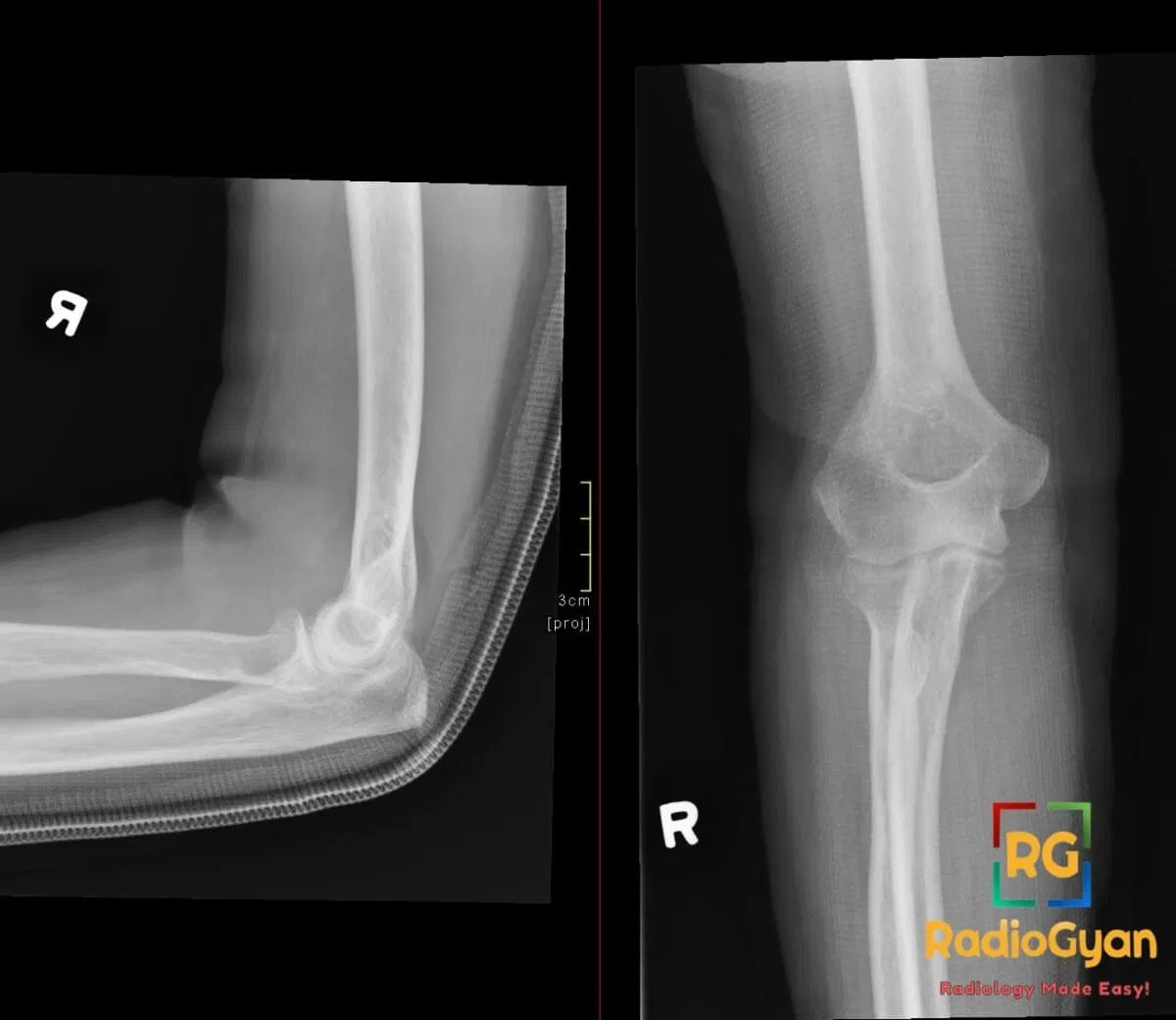 X-ray showing right radial neck fracture with visible lipohemarthrosis in the elbow joint.