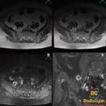 T2W MRI showing a retroperitoneal schwannoma with characteristic target sign.
