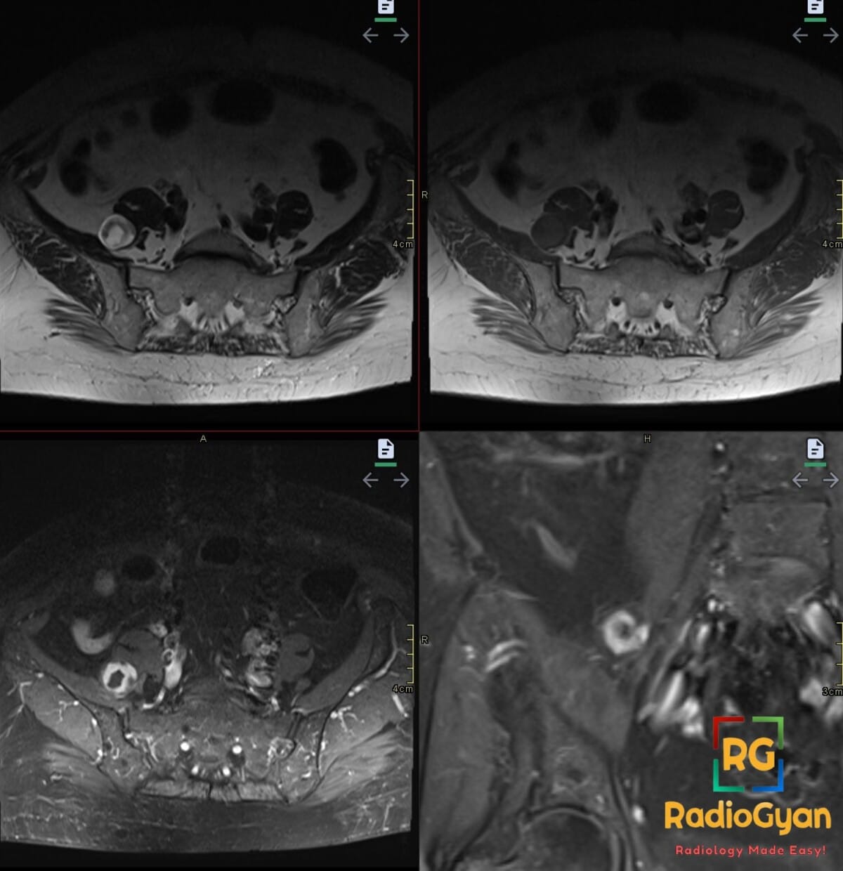 T2W MRI showing a retroperitoneal schwannoma with characteristic target sign.