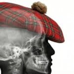 Lateral skull X-ray displaying the Tam O'Shanter Hat sign, characteristic of Paget's disease of the bone.