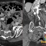 CT scan of sacrum revealing Tarlov cysts, with axial and coronal views of fluid-filled lesions.