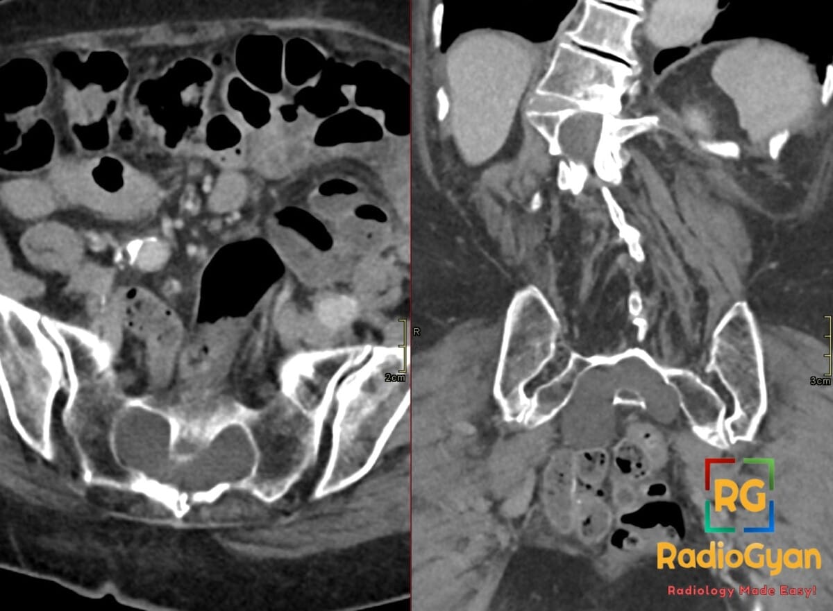 CT scan of sacrum revealing Tarlov cysts, with axial and coronal views of fluid-filled lesions.