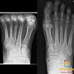 Anteroposterior X-ray of the foot demonstrating a stress fracture at the neck of the third metatarsal bone.
