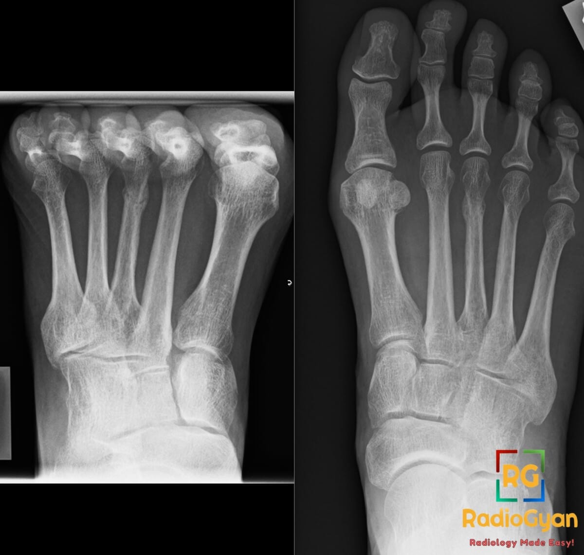 Anteroposterior X-ray of the foot demonstrating a stress fracture at the neck of the third metatarsal bone.