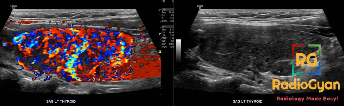 Color Doppler ultrasound of the thyroid gland showing markedly increased vascularity consistent with thyroid inferno in Graves' disease.