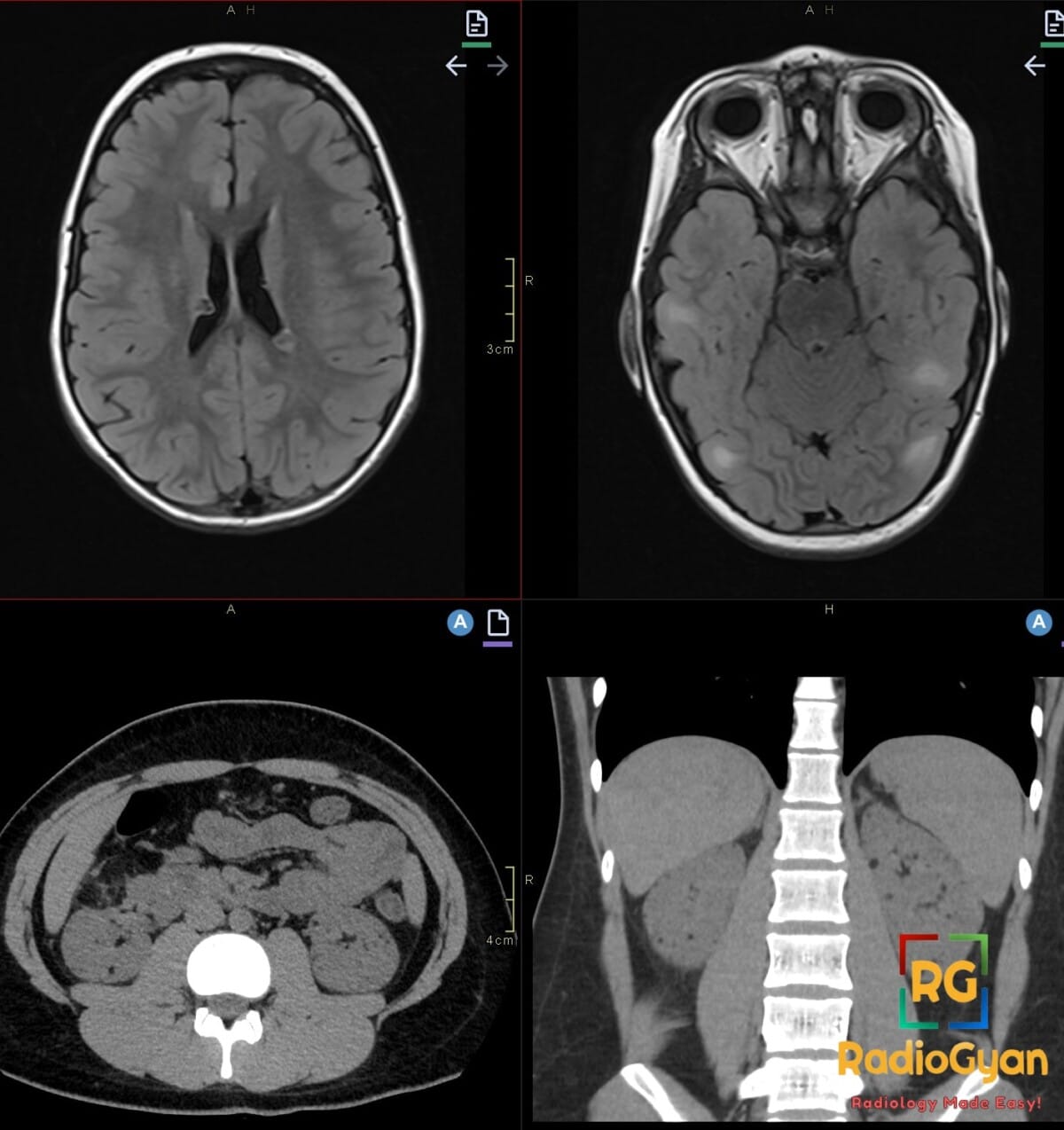MRI brain and CT abdomen: Tuberous sclerosis with cortical tubers, subependymal nodules, and bilateral renal angiomyolipomas.