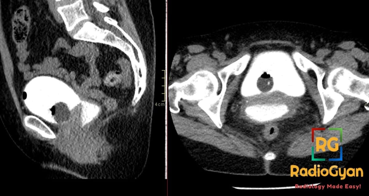 CT cystogram showing vesicovaginal fistula in post-hysterectomy patient