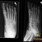 X-ray of the right foot showing an avulsion fracture of the 5th metatarsal bone in AP and oblique views.