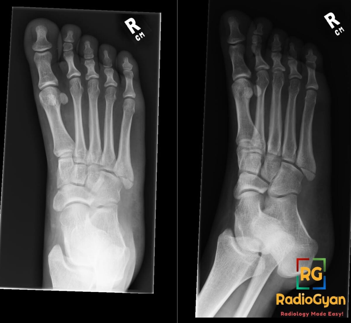 X-ray of the right foot showing an avulsion fracture of the 5th metatarsal bone in AP and oblique views.