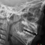 Lateral skull X-ray showing hypertrophied adenoids in a 3-year-old child causing airway narrowing and symptoms.
