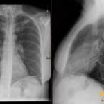 AP and lateral chest X-ray showing an Amplatzer Septal Occluder device implanted for an atrial septal defect (ASD).