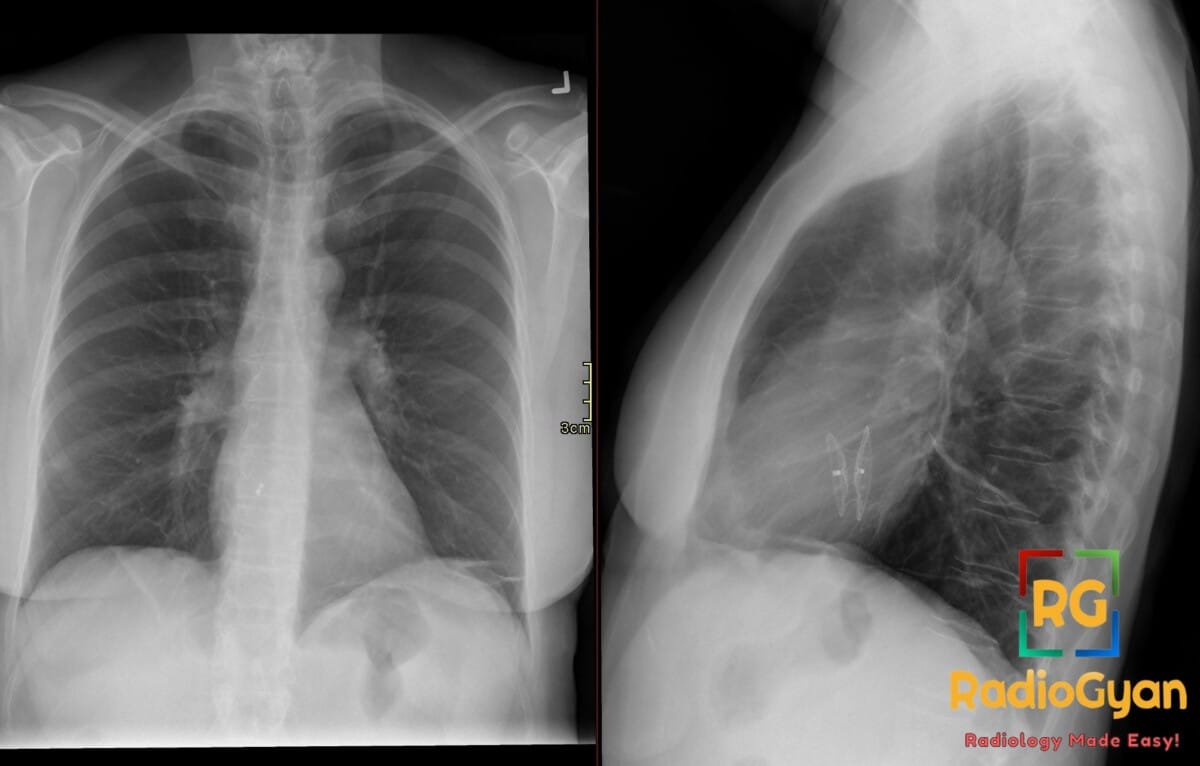 AP and lateral chest X-ray showing an Amplatzer Septal Occluder device implanted for an atrial septal defect (ASD).