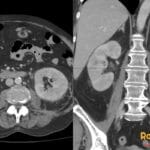 CT scan showing bilateral acute pyelonephritis with right pyelitis, characterized by renal changes and inflammation.