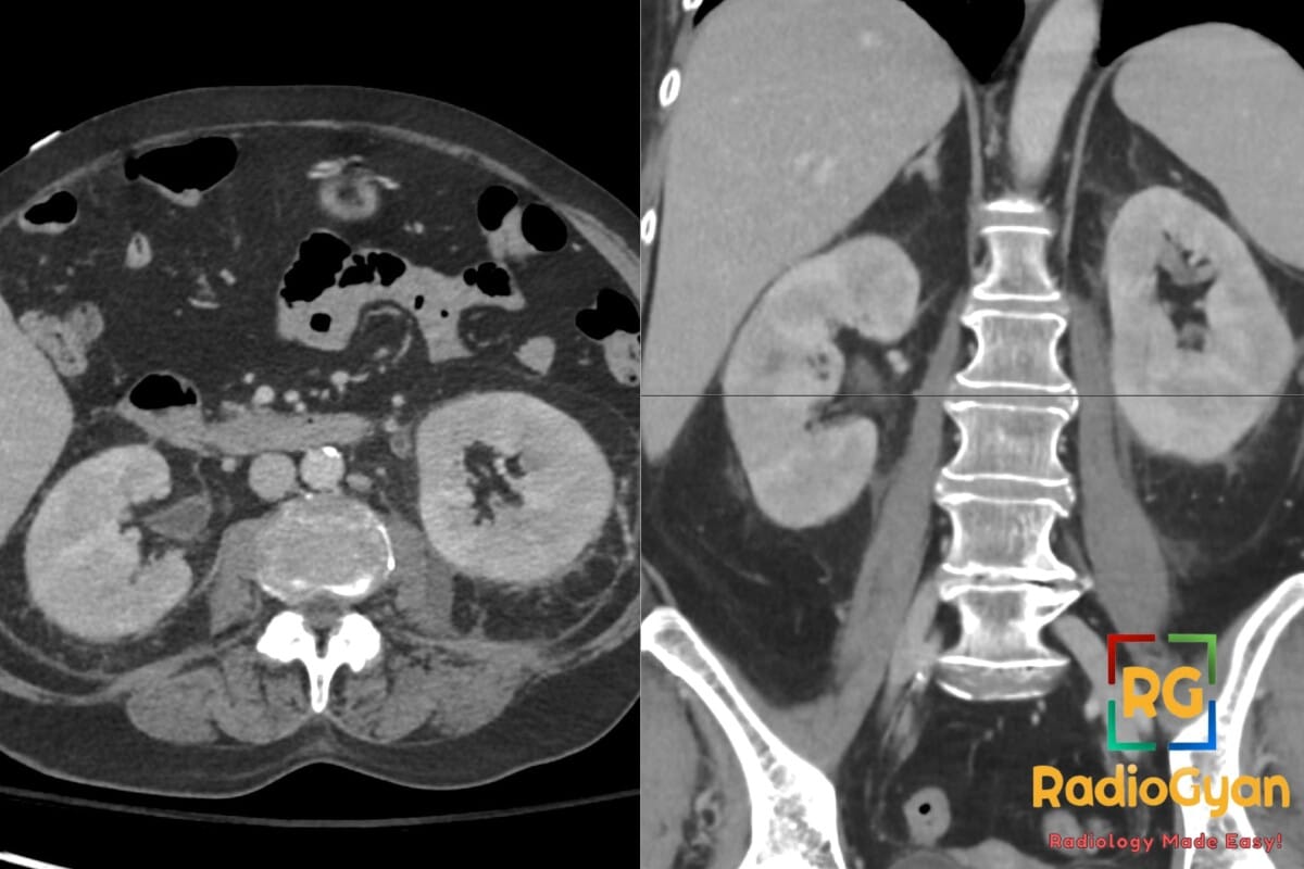 CT scan showing bilateral acute pyelonephritis with right pyelitis, characterized by renal changes and inflammation.