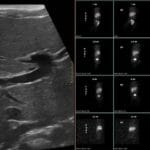 Ultrasound showing triangular cord sign and hepatobiliary scan indicating lack of hepatic excretion, diagnostic for biliary atresia.