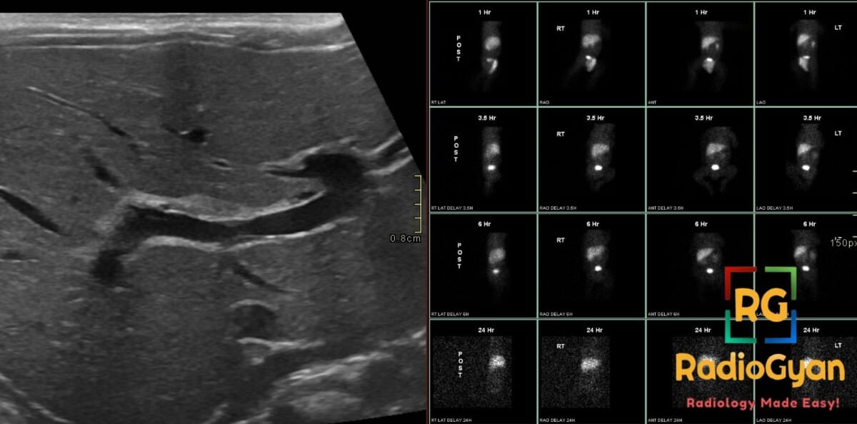 Ultrasound showing triangular cord sign and hepatobiliary scan indicating lack of hepatic excretion, diagnostic for biliary atresia.