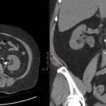 CT scan showing emphysematous pyelitis with gas in the renal pelvis and a non-obstructing left renal calculus.