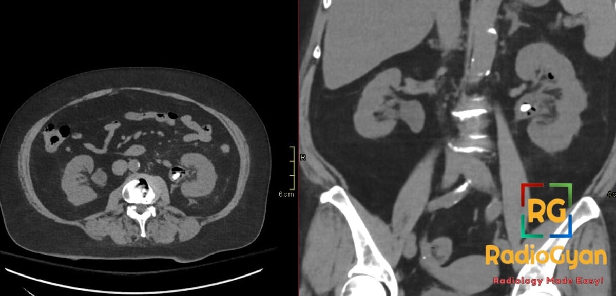 CT scan showing emphysematous pyelitis with gas in the renal pelvis and a non-obstructing left renal calculus.