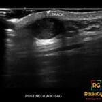 Ultrasound image of the post neck showing an epidermal inclusion cyst with an associated track leading to the skin.