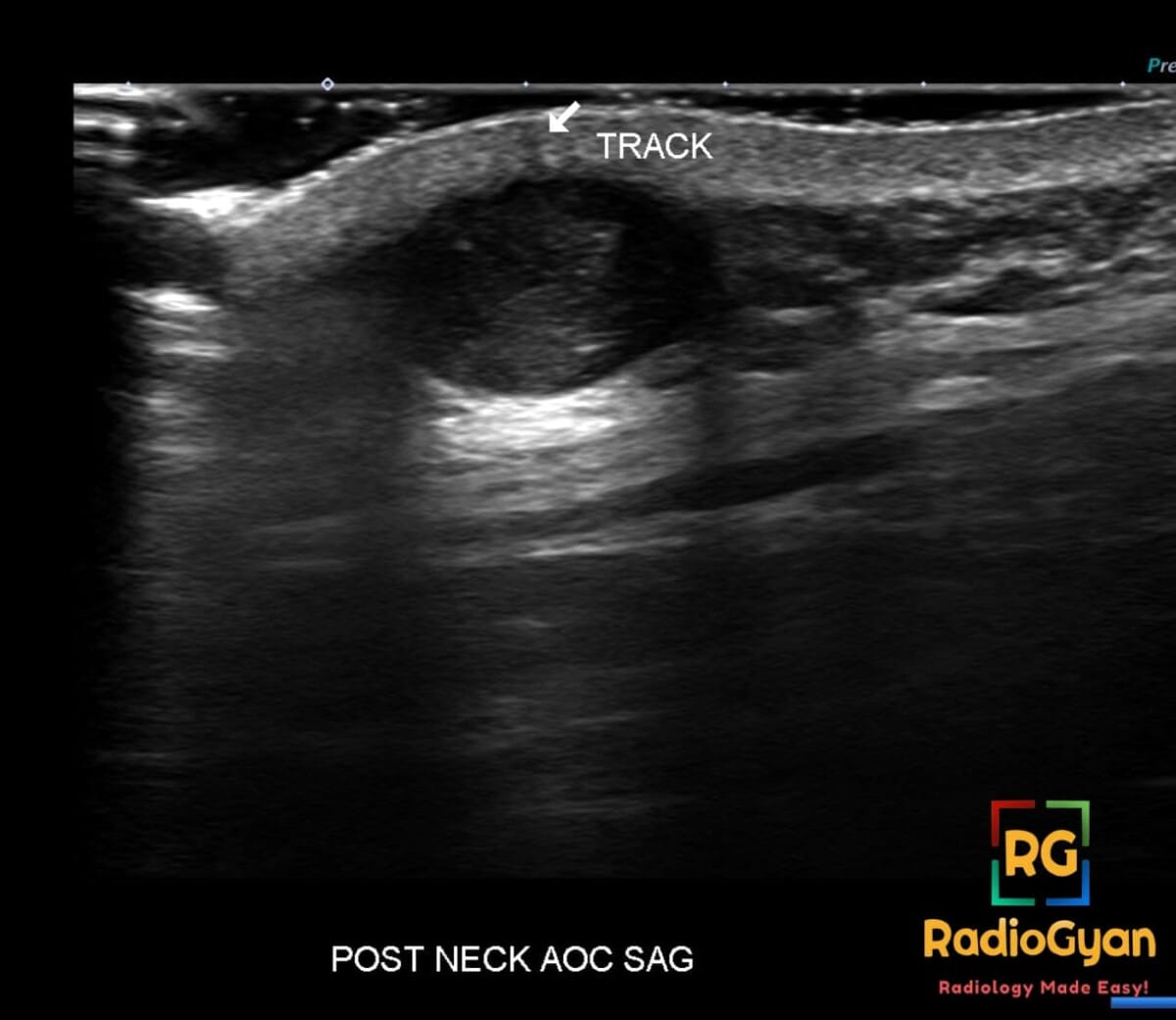 Ultrasound image of the post neck showing an epidermal inclusion cyst with an associated track leading to the skin.