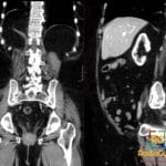 Coronal and sagittal CT images showing a fat-containing right posterior diaphragmatic hernia, also known as a Bochdalek hernia.