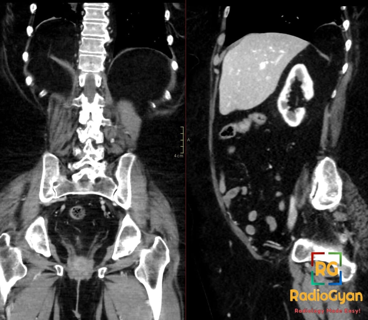 Coronal and sagittal CT images showing a fat-containing right posterior diaphragmatic hernia, also known as a Bochdalek hernia.