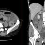 Axial and coronal CT scans showing ileoileal intussusception in the left lower quadrant causing small bowel obstruction.