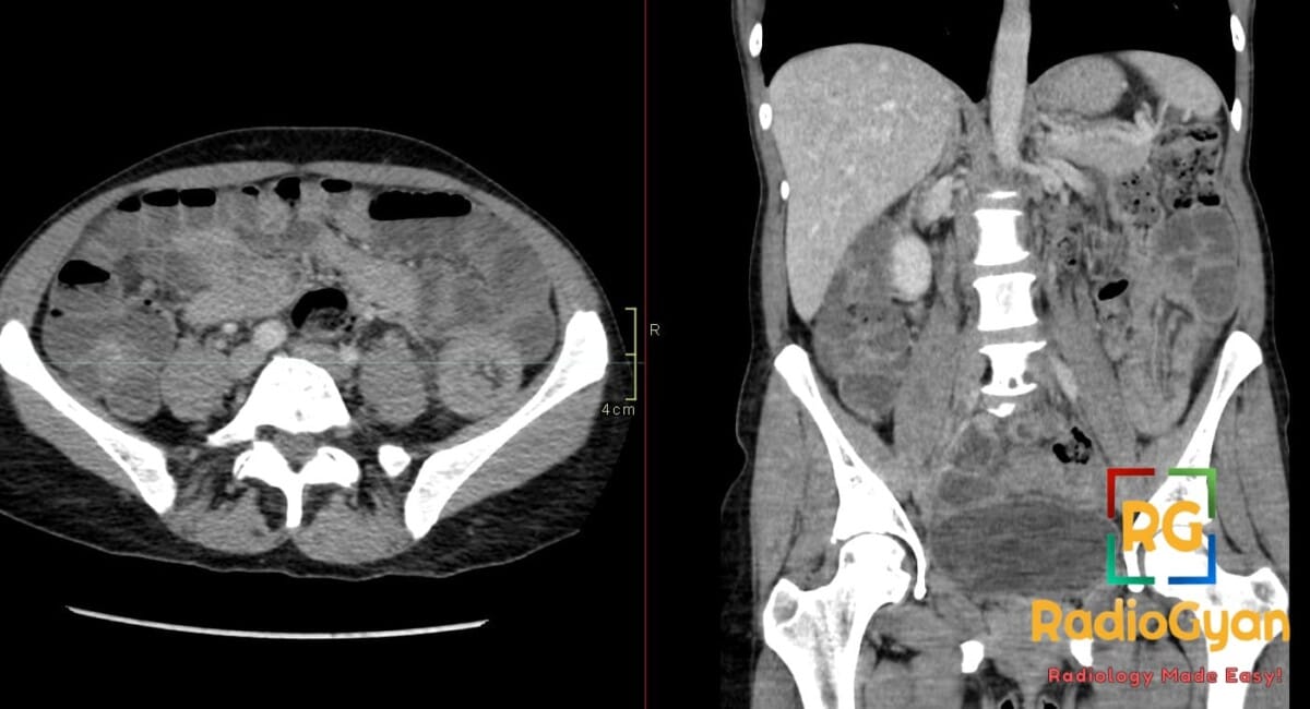 Axial and coronal CT scans showing ileoileal intussusception in the left lower quadrant causing small bowel obstruction.