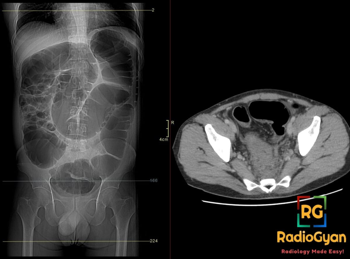 CT scan showing large bowel obstruction with dilated colon and a rectosigmoid tumor causing extrinsic compression.