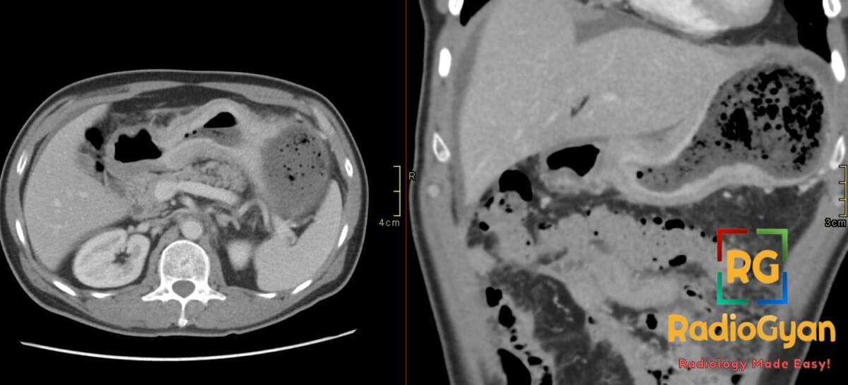CT scan showing diffuse gastric wall thickening characteristic of a leather bottle stomach due to gastric cancer.