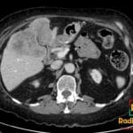 Axial CT scan of abdomen showing a large, irregular mass in the liver suggestive of cholangiocarcinoma.