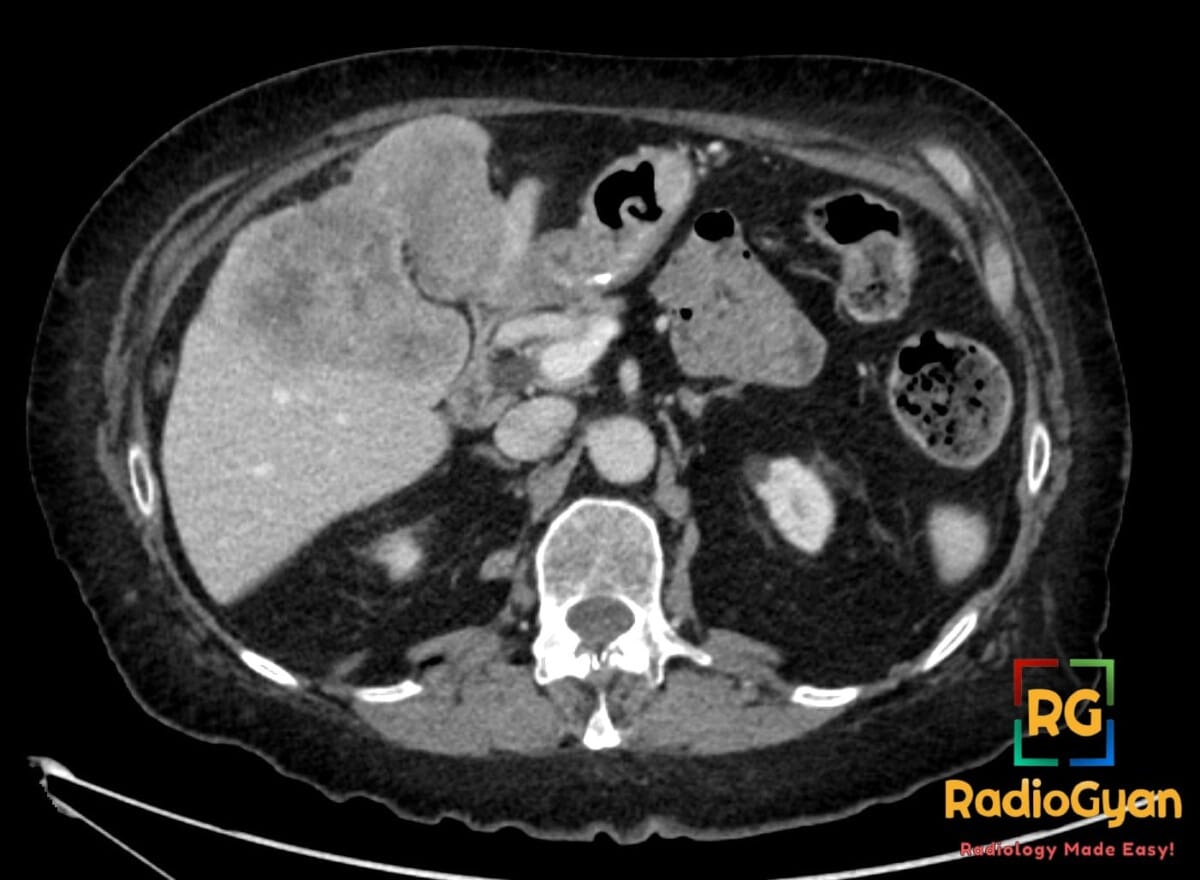 Axial CT scan of abdomen showing a large, irregular mass in the liver suggestive of cholangiocarcinoma.