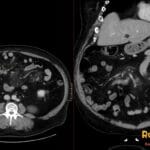 CT scan showing mesenteric panniculitis and developing lymphoma in the right paramidline mesentery, with measurements.