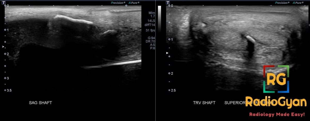 Ultrasound images of the penile shaft depicting calcified plaques consistent with Peyronie's disease.