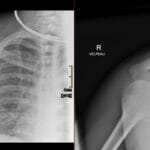 X-rays of right shoulder showing acromioclavicular joint injury.